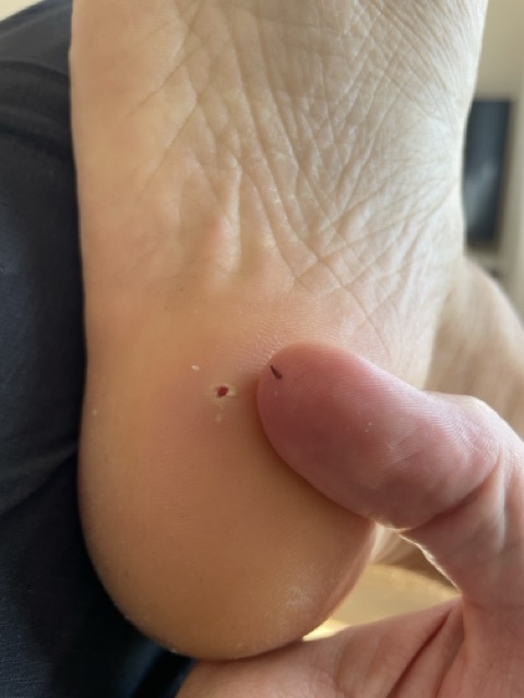 Removing splinter from foot