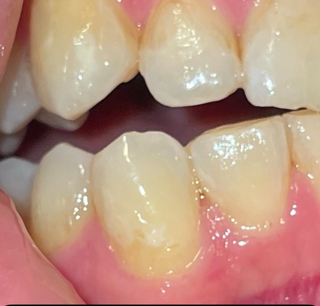 Teeth with gums - enlarged